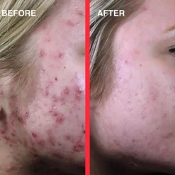 Acne Light Shot