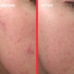 Acne Light Shot