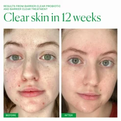 Barrier Clear Treatment 30ML