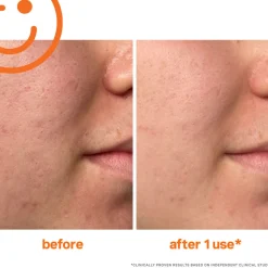Exfolikate Intensive Exfoliating Treatment 15ML